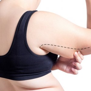 Kol Germe (Brakioplasti)