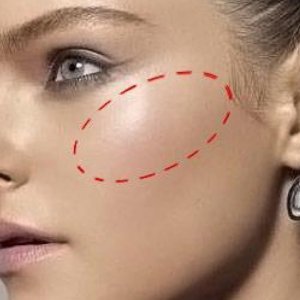 Yanak Ve Elmacık Kemiği Dolgusu