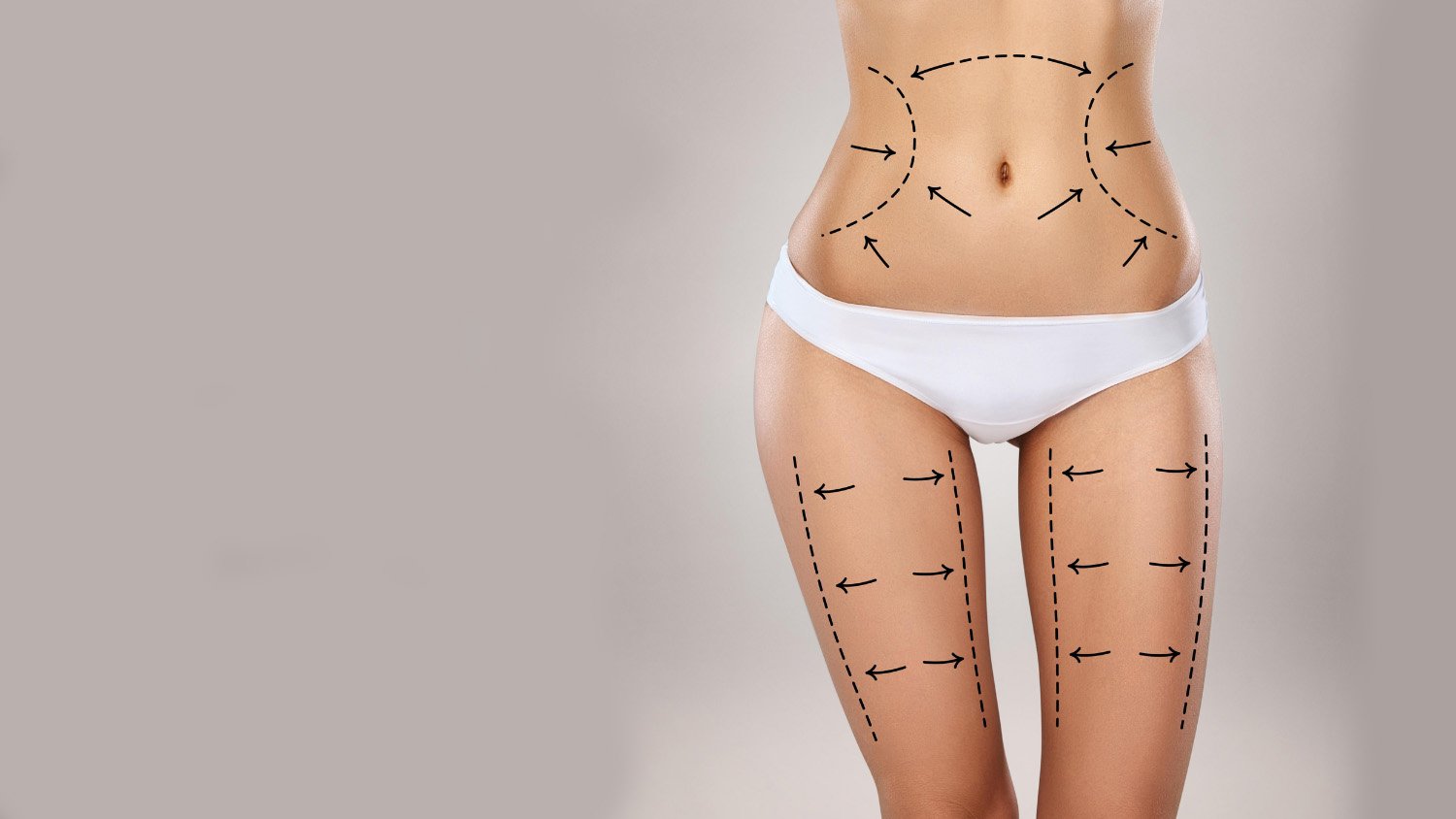 LIPOSUCTION